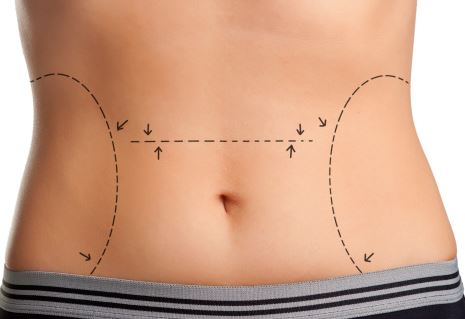 Before and after images of abdominoplasty
