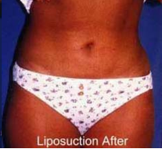 Dr. Weiss consulting with a liposuction patient.