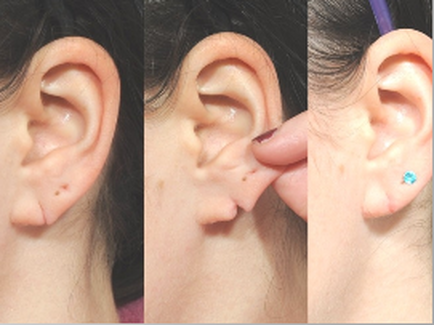 before and after images of earlob repair by Dr. Weiss