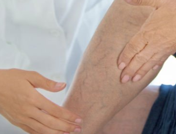 before and after images of spider veins and vein sclerosing procedures by Dr. Weiss